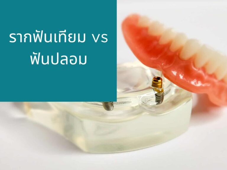 รากฟันเทียม vs ฟันปลอม แบบไหนดีกว่ากัน