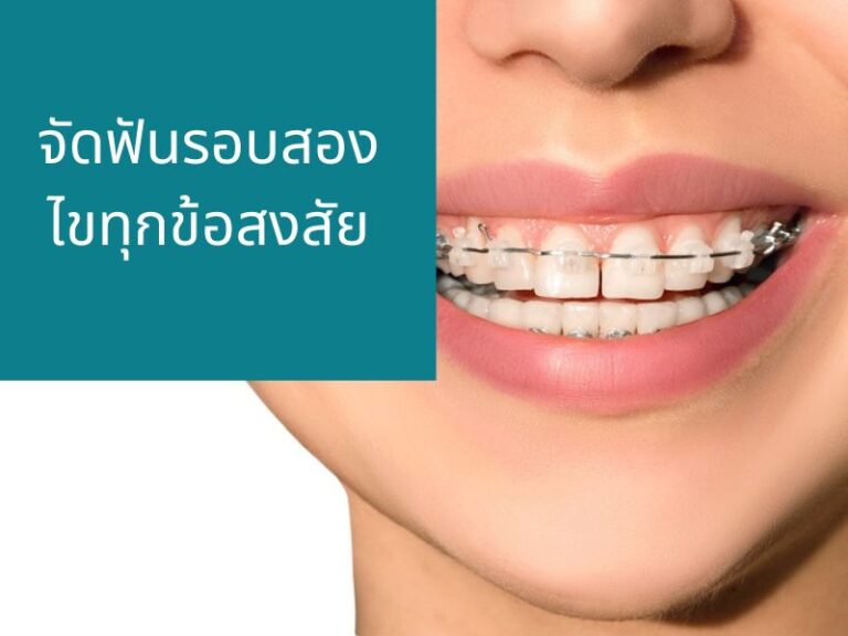 จัดฟันรอบสอง ข้อควรรู้ก่อนการรักษา